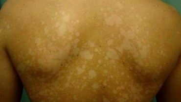 remedios caseros hongos de la piel