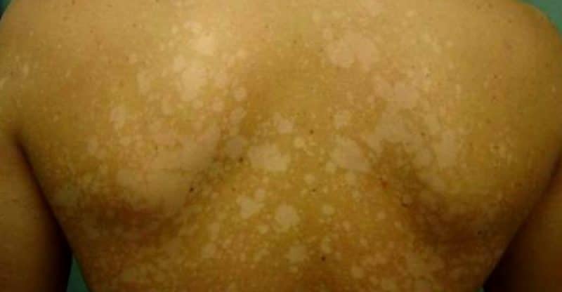 remedios caseros hongos de la piel