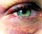 remedios caseros ojo morado