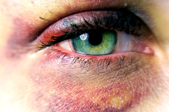 remedios caseros ojo morado