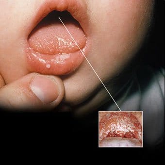 úlceras en la boca de un bebé